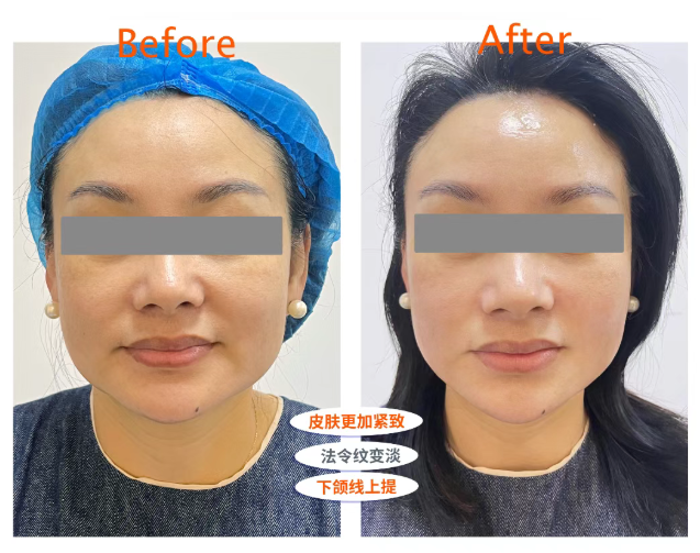 一起“躺瘦”吧｜紧霸智能射频燃脂：科技塑美，精准焕新(图2)