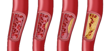 阿托伐他汀是治什么的?优选原研药、长期使用,有效降脂第一步(图1) 阿托伐他汀是治什么的?优选原研药、长期使用,有效降脂第一步(图1)